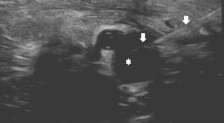 Echogeleide percutane punctie van een arthrosynoviale cyste (asterisk) aan de binnenenkel, verantwoordelijk voor een tarsaal tunnel syndroom