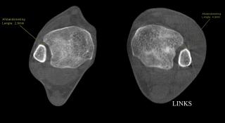 Letsel van de syndesmose, zichtbaar via PedCAT