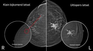 Illustratie beeldvorming contrast-mammografie