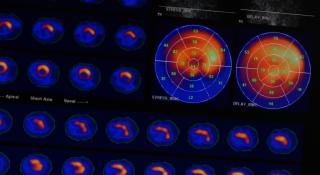 Resultaten scan van het hart met contrastvloeistof en stress